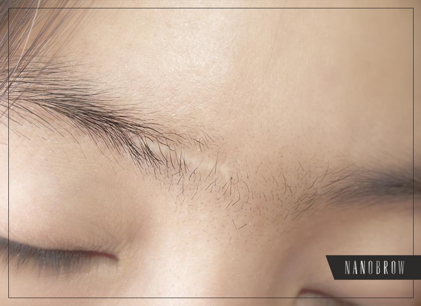 傷跡をメイクでカバーする